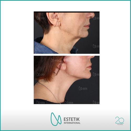 Before after photos of our patients 8
